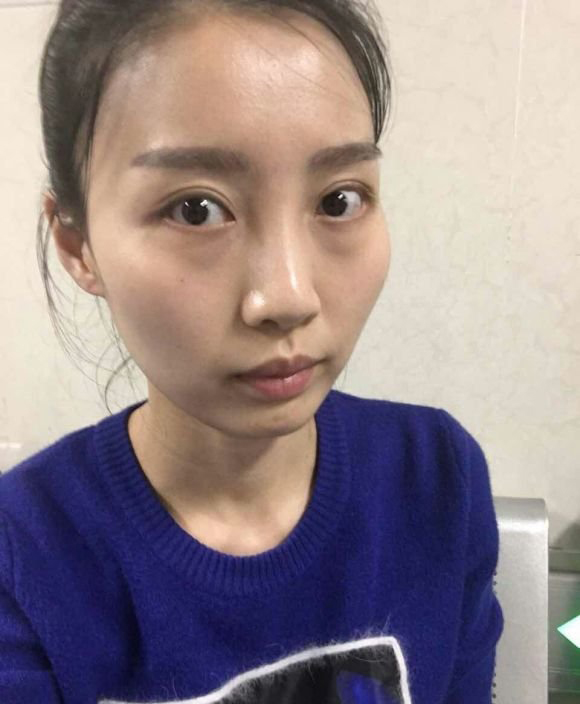 徐威强磨骨怎么样？【案例】