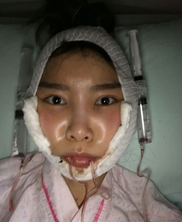 徐威强磨骨怎么样？【案例】