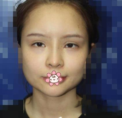 广州徐威强改脸型效果怎么样？好不好？看六个月案例图