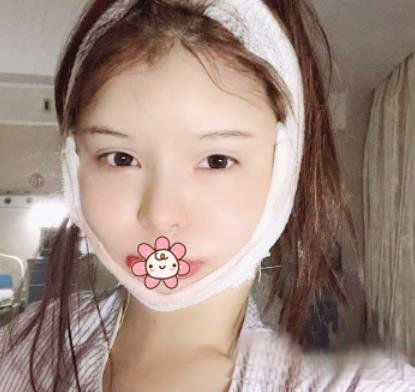 广州徐威强改脸型效果怎么样？好不好？看六个月案例图