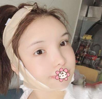 广州徐威强改脸型效果怎么样？好不好？看六个月案例图