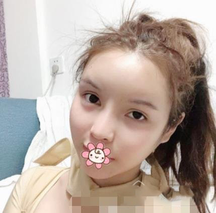 广州徐威强改脸型效果怎么样？好不好？看六个月案例图