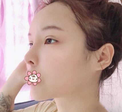 广州徐威强改脸型效果怎么样？好不好？看六个月案例图