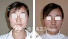 咬肌肥大，注射后变成了瓜子脸