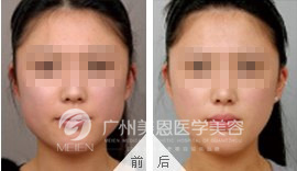 因咀嚼咬肌肥大注射前后对比图