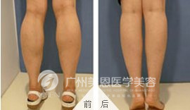 注射后后小腿又恢复纤长了