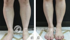 肌肉型瘦小腿前后对比图