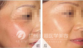 BOTOX去除鱼尾纹前后对比图