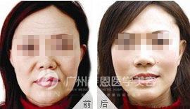 面部皱纹通通不见