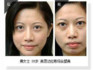 黄女士 28岁 美恩达拉斯综合塑鼻
