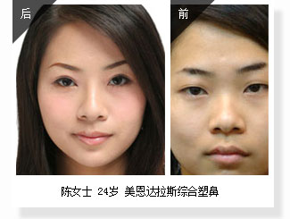 陈女士 24岁 美恩达拉斯综合塑鼻