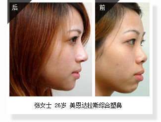 张女士 26岁 美恩达拉斯综合塑鼻