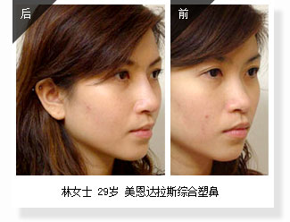 林女士 29岁 美恩达拉斯综合塑鼻
