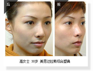 高女士 30岁 美恩达拉斯综合塑鼻