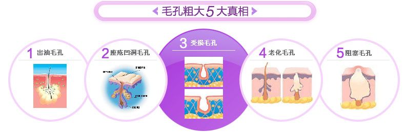 毛孔粗大5大真相